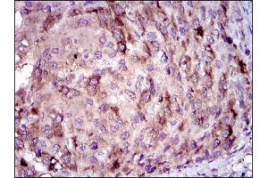 Immunohistochemical analysis of paraffin-embedded liver cancer tissues using CRP mouse mAb with DAB staining. (CRP anticorps)