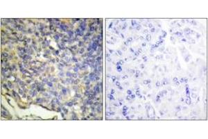 Immunohistochemistry analysis of paraffin-embedded human breast carcinoma tissue, using DFFA Antibody. (DFFA anticorps  (AA 151-200))