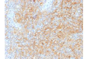 Formalin-fixed, paraffin-embedded human Hodgkins Lymphoma stained with CD40 Mouse Monoclonal Antibody (C40/1605). (CD40 anticorps)