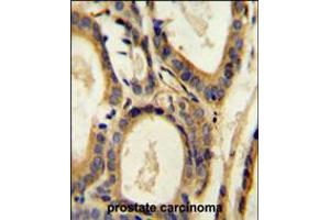 CCL4 Antibody immunohistochemistry analysis in formalin fixed and paraffin embedded human prostate carcinoma followed by peroxidase conjugation of the secondary antibody and DAB staining. (CCL4 anticorps  (AA 22-48))