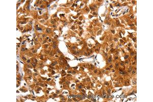 Immunohistochemistry of Human lung cancer using ADAP1 Polyclonal Antibody at dilution of 1:60 (ADAP1 anticorps)