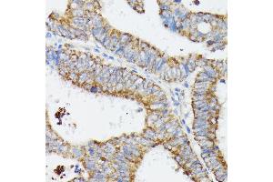 Immunohistochemistry of paraffin-embedded human colon carcinoma using MT-CYB antibody (ABIN7268595) at dilution of 1:100 (40x lens). (Cytochrome b anticorps)