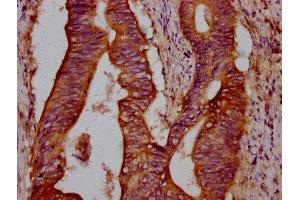 IHC image of ABIN7175220 diluted at 1:300 and staining in paraffin-embedded human colon cancer performed on a Leica BondTM system.