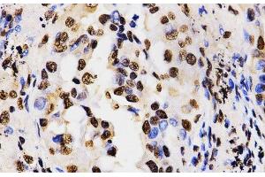 Immunohistochemistry of paraffin-embedded Human lung cancer using Asymmetric DiMethyl-Histone H3-R17 Polyclonal Antibody at dilution of 1:200 (40x lens).