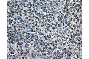 Immunohistochemical staining of paraffin-embedded Adenocarcinoma of ovary tissue N93ing anti-ARNT mouse monoclonal antibody. (ARNT anticorps)