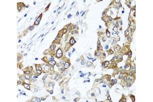 Immunohistochemistry of paraffin-embedded Human colon carcinoma using PPOX Polyclonal Antibody at dilution of 1:100 (40x lens). (PPOX anticorps)