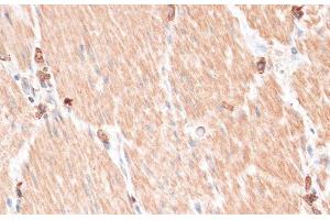 Immunohistochemistry of paraffin-embedded Human gastric cancer using ABCB7 Polyclonal Antibody at dilution of 1:100 (40x lens).