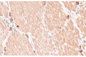 Immunohistochemistry of paraffin-embedded Human gastric cancer using ABCB7 Polyclonal Antibody at dilution of 1:100 (40x lens). (ABCB7 anticorps)