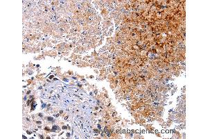 Immunohistochemistry of Human lung cancer using HMOX1 Polyclonal Antibody at dilution of 1:40 (HMOX1 anticorps)