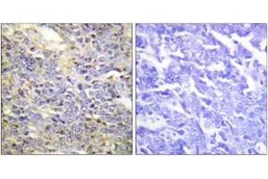 Immunohistochemistry analysis of paraffin-embedded human lung carcinoma tissue, using Caspase 9 (Ab-125) Antibody. (Caspase 9 anticorps  (AA 91-140))