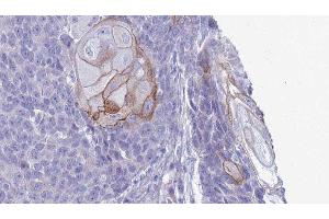 ABIN6279758 at 1/100 staining Human Head and neck cancer tissue by IHC-P. (RGS21 anticorps  (N-Term))