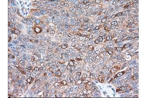 Immunohistochemical staining of paraffin-embedded Adenocarcinoma of Human colon tissue using anti-TACC3 mouse monoclonal antibody. (TACC3 anticorps)
