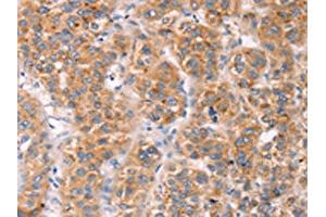 The image on the left is immunohistochemistry of paraffin-embedded Human liver cancer tissue using ABIN7191466(MLNR Antibody) at dilution 1/45, on the right is treated with synthetic peptide. (Motilin Receptor anticorps)