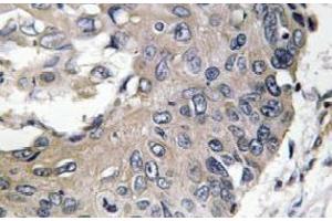 Immunohistochemistry analysis of ApoE Antibody in paraffin-embedded human lung carcinoma tissue. (APOE anticorps)