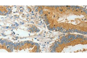 Immunohistochemistry of paraffin-embedded Human colon cancer using BAAT Polyclonal Antibody at dilution of 1:30 (BAAT anticorps)