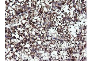 Immunohistochemical staining of paraffin-embedded Carcinoma of Human kidney tissue using anti-MPI mouse monoclonal antibody. (MPI anticorps)