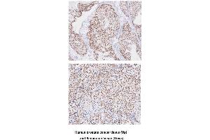 Paraffin embedded sections of human prostate cancer and seminoma tissue were incubated with anti-human TARDBP(1:50) for 2 hours at room temperature.