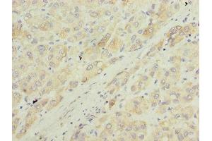 Immunohistochemistry of paraffin-embedded human liver cancer using ABIN7143985 at dilution of 1:100