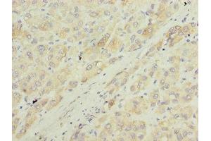 Immunohistochemistry of paraffin-embedded human liver cancer using ABIN7143985 at dilution of 1:100 (Monoamine Oxidase A anticorps  (AA 1-300))