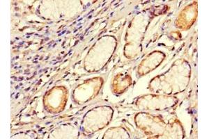 Immunohistochemistry of paraffin-embedded human gastric cancer using ABIN7170420 at dilution of 1:100