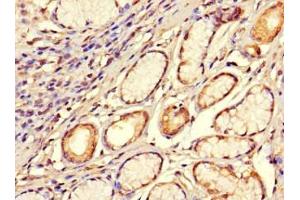 Immunohistochemistry of paraffin-embedded human gastric cancer using ABIN7170420 at dilution of 1:100 (SMOC1 anticorps  (AA 277-382))
