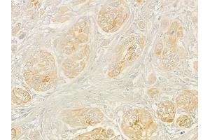 ABIN6263204 and ABIN6268937 at 1/100 staining human tongue carcinoma by IHC-P. (MEF2C anticorps  (C-Term))