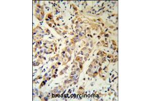 KRT13 Antibody (RB18903) IHC analysis in formalin fixed and paraffin embedded human breast carcinoma followed by peroxidase conjugation of the secondary antibody and DAB staining.