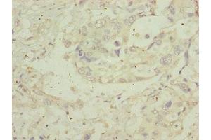 Immunohistochemistry of paraffin-embedded human pancreatic cancer using ABIN7159922 at dilution of 1:100 (MIPEP anticorps  (AA 504-713))