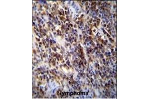 Parp9 Antibody (C-term) (ABIN655613 and ABIN2845094) immunohistochemistry analysis in formalin fixed and paraffin embedded human lymphoma followed by peroxidase conjugation of the secondary antibody and DAB staining. (PARP9 anticorps  (AA 599-629))