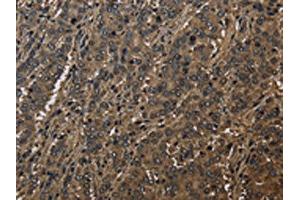 The image on the left is immunohistochemistry of paraffin-embedded Human liver cancer tissue using ABIN7129664(GSTO1 Antibody) at dilution 1/60, on the right is treated with fusion protein. (GSTO1 anticorps)