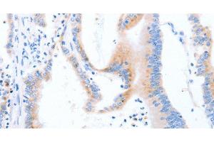 Immunohistochemistry of paraffin-embedded Human colon cancer using STK4 Polyclonal Antibody at dilution of 1:70 (STK4 anticorps)