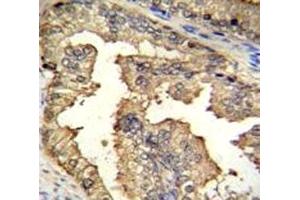 IHC testing of PRMT4 antibody and FFPE human prostate carcinoma.