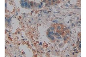 Detection of NGAL in Human Pancreatic cancer Tissue using Polyclonal Antibody to Neutrophil gelatinase-associated lipocalin (NGAL)
