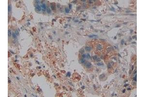 Detection of NGAL in Human Pancreatic cancer Tissue using Polyclonal Antibody to Neutrophil gelatinase-associated lipocalin (NGAL) (Lipocalin 2 anticorps  (AA 21-198))