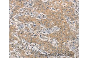 Immunohistochemistry of Human gastric cancer using NFE2L1 Polyclonal Antibody at dilution of 1:30 (NFE2L1 anticorps)