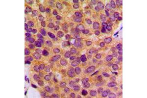 Immunohistochemical analysis of MMP19 staining in human breast cancer formalin fixed paraffin embedded tissue section.