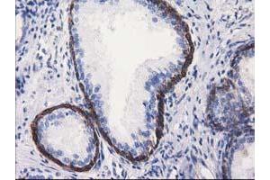Immunohistochemical staining of paraffin-embedded Carcinoma of Human kidney tissue using anti-ALDH1L1 mouse monoclonal antibody. (ALDH1L1 anticorps)