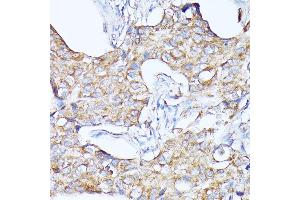 Immunohistochemistry of paraffin-embedded human breast cancer using CTSF antibody (ABIN6127667, ABIN6139225, ABIN6139226 and ABIN6214736) at dilution of 1:100 (40x lens).