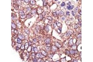 IHC analysis of FFPE human breast carcinoma tissue stained with the SYVN1 antibody