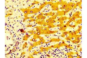 IHC image of ABIN7149243 diluted at 1:400 and staining in paraffin-embedded human liver cancer performed on a Leica BondTM system.