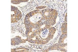 Immunohistochemistry of paraffin embedded human colon cancer using IFIT5 (ABIN7074334) at dilution of 1:500 (200x lens) (IFIT5 anticorps)
