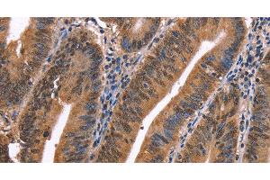 Immunohistochemistry of paraffin-embedded Human colon cancer using EVC2 Polyclonal Antibody at dilution of 1:40 (EVC2 anticorps)