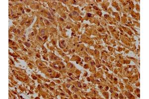 IHC image of ABIN7147175 diluted at 1:500 and staining in paraffin-embedded human lung cancer tissue performed on a Leica BondTM system. (CD63 anticorps  (AA 103-203))
