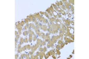 Immunohistochemistry of paraffin-embedded human liver injury using ACP1 antibody (ABIN6289983) at dilution of 1:100 (40x lens). (ACP1 anticorps)