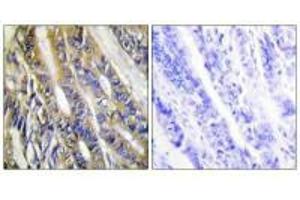 Immunohistochemistry analysis of paraffin-embedded human colon carcinoma tissue, using DGKH antibody. (DGKH anticorps)