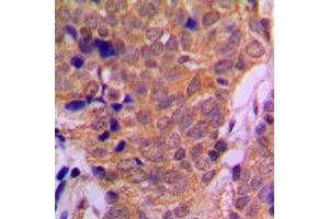 Immunohistochemical analysis of Histone Deacetylase 6 staining in human breast cancer formalin fixed paraffin embedded tissue section. (HDAC6 anticorps  (C-Term))