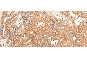 Immunohistochemistry of paraffin-embedded Human liver cancer tissue using CPS1 Polyclonal Antibody at dilution of 1:35(x200) (CPS1 anticorps)
