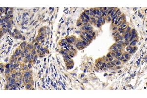 Detection of Bcl2L in Human Lymphoma Tissue using Polyclonal Antibody to B-Cell CLL/Lymphoma 2 Like Protein (Bcl2L)