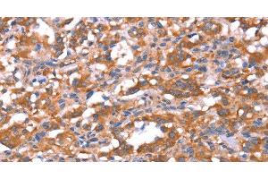 Immunohistochemistry of paraffin-embedded Human thyroid cancer tissue using FAM13B Polyclonal Antibody at dilution 1:30 (FAM13B anticorps)