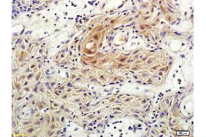 Formalin-fixed and paraffin embedded human vulvar cancer labeled with Anti-Rho C Polyclonal Antibody, Unconjugated (ABIN687157) followed by conjugation to the secondary antibody and DAB staining (RHOC anticorps  (AA 101-193))